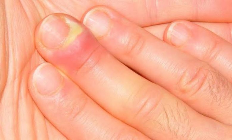 5 أعراض على الأصابع تشير للإصابة بمرض خطير