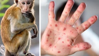 «الصحة العالمية»: «جدري القردة».. حالة طوارئ عالمية