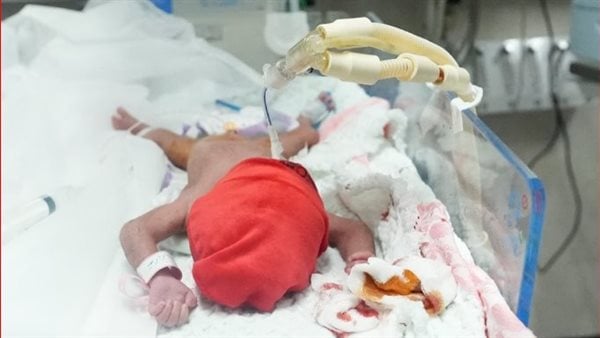ارتفاع في عدد الولادات المبكرة بغزة .. إخراج الأجنة من بطون الأمهات المحتضرات