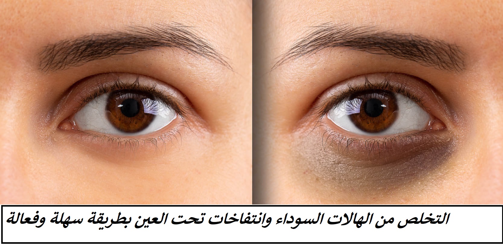 وصفة سحرية جبارة للتخلص من الهالات السوداء تحت العين والانتفاخات حول العين